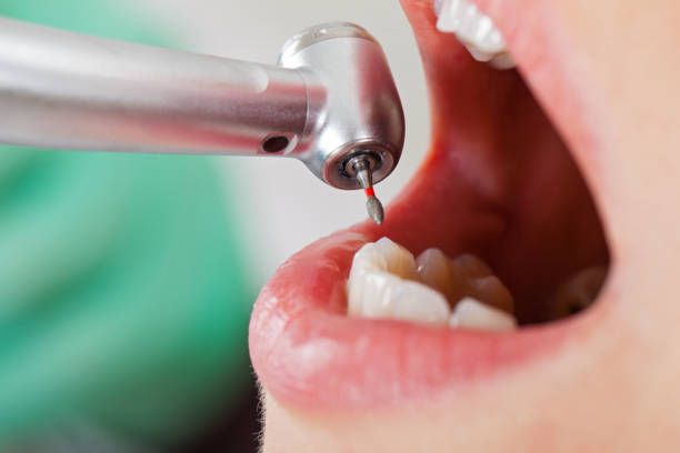 Best Dentist for Tooth Abscess  in Northgate, OH